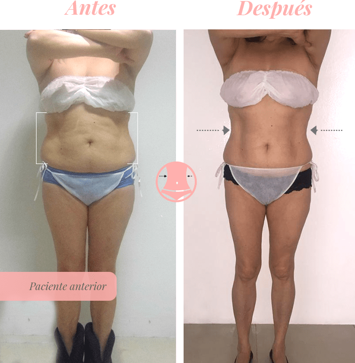 Mesoterapia Corporal En Promoestetica - Antes y después