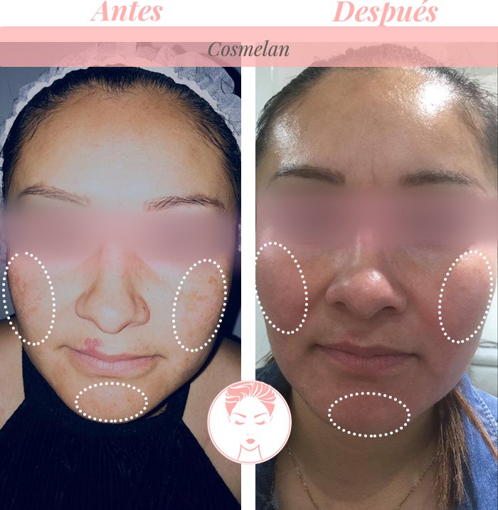 Despigmentante facial cosmelan tratamiento