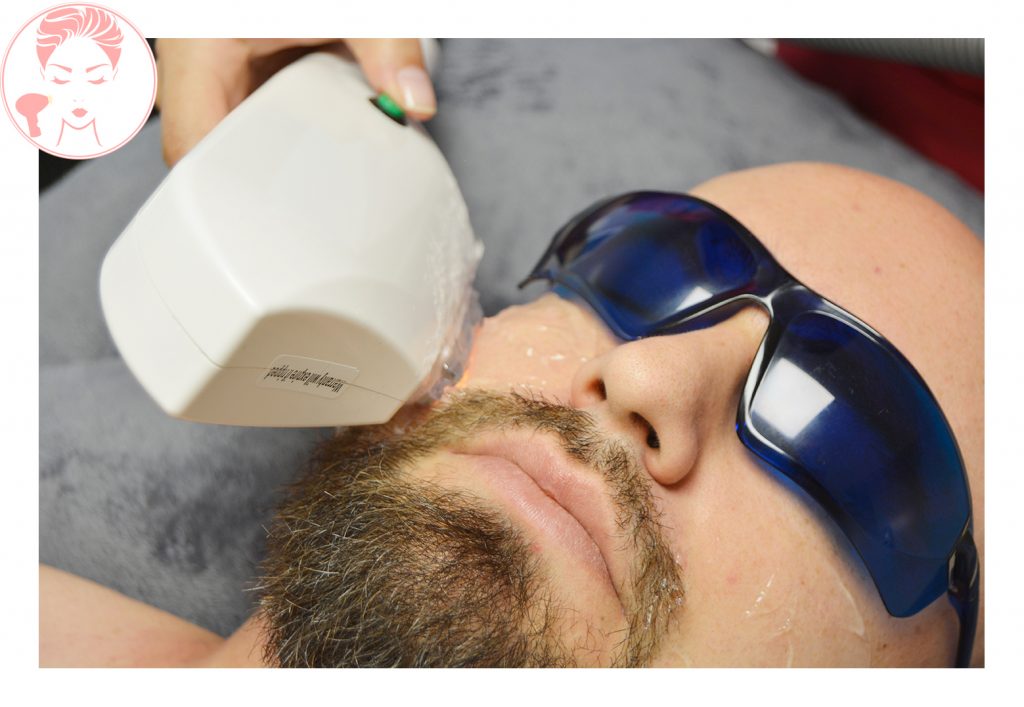 Procedimiento de Depilación láser en Barba en Promoestetica