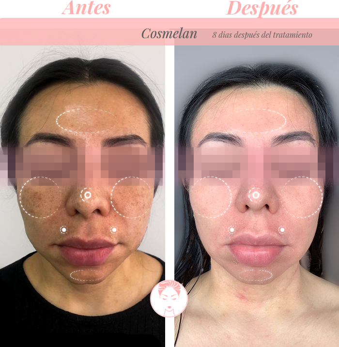 Despigmentante facial cosmelan tratamiento