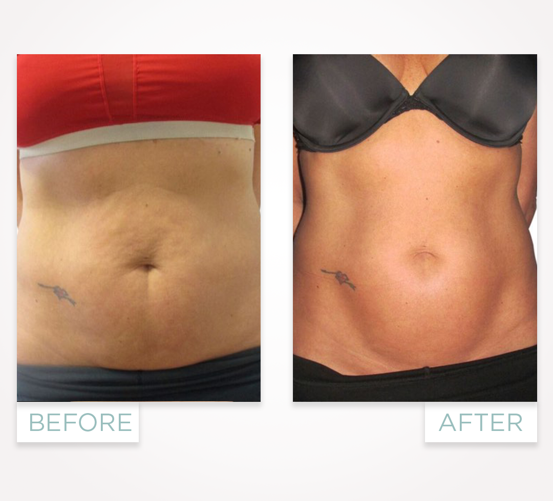 Venus y Crioliposlisis corporal resultados en Promoestetica