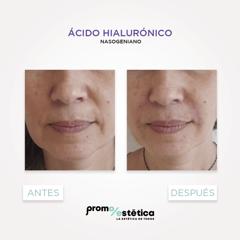 Acido hialuronico en nasogenianos antes y despues