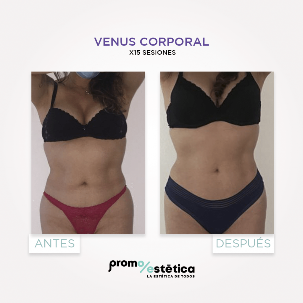 Reduce celulitis con Venus Corporal en Promoestetica - Resultados
