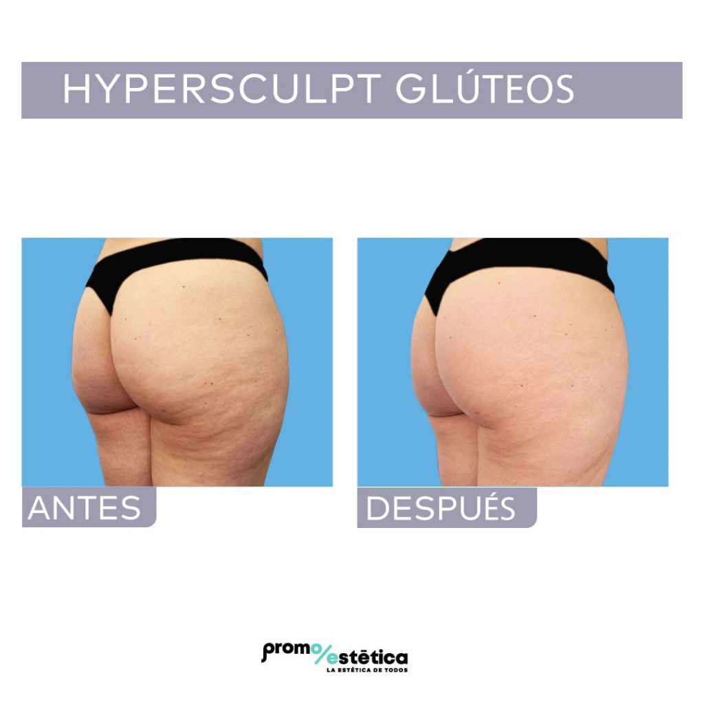 Antes y después de levantamiento de gluteos con Hypersculpt en Promoestetica