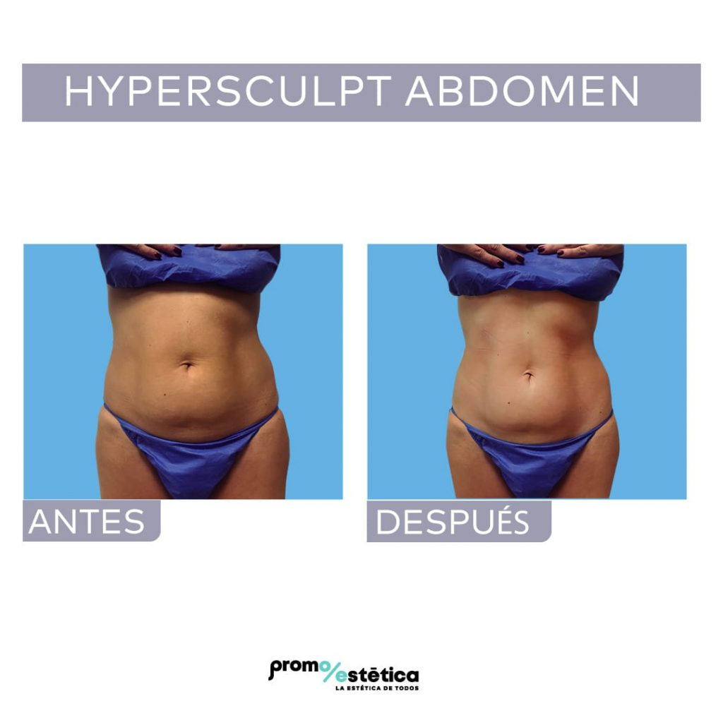 Marcación abdominal con Hypersculpt en Promoestetica - Antes y después