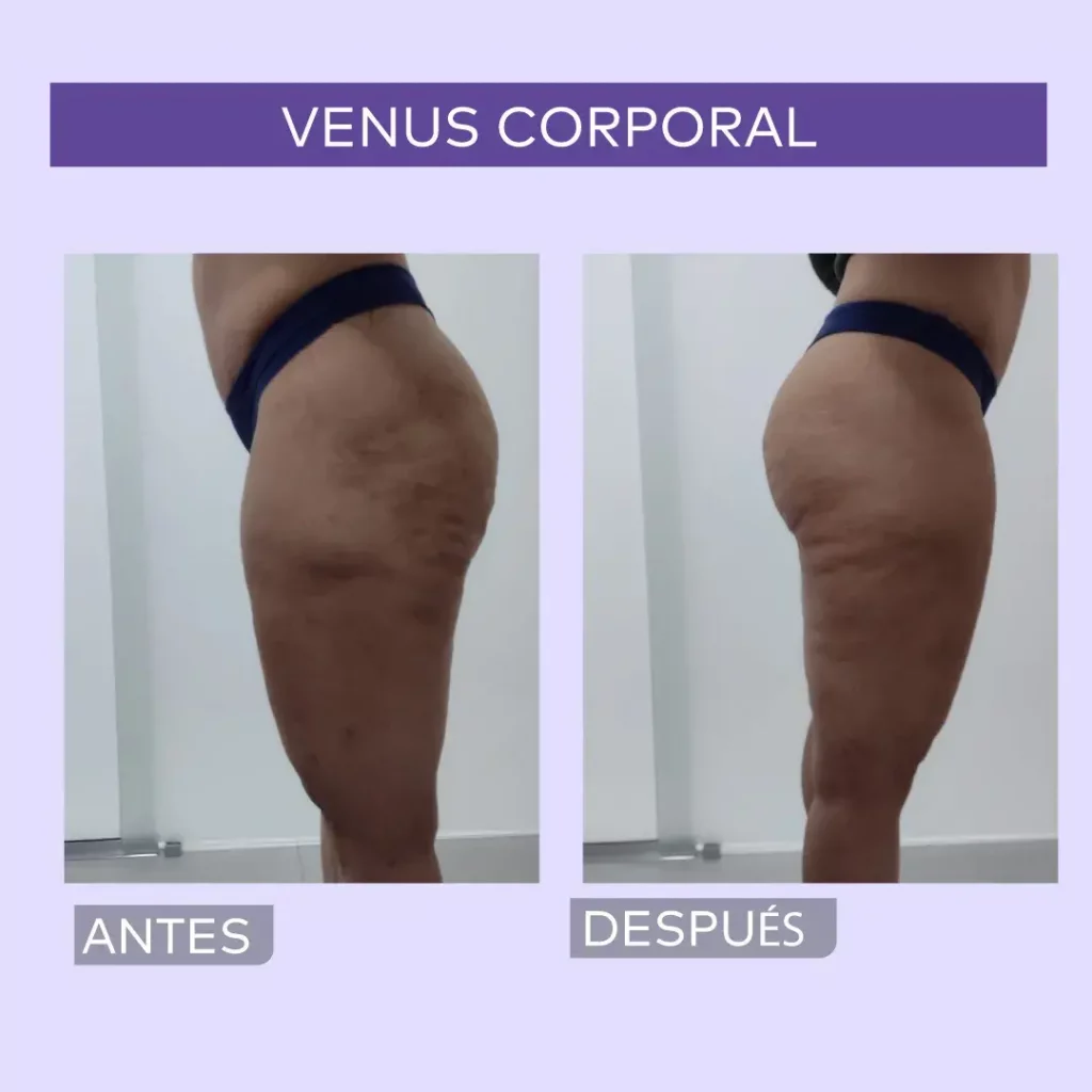 Venus Corporal Resultados en Promoestetica