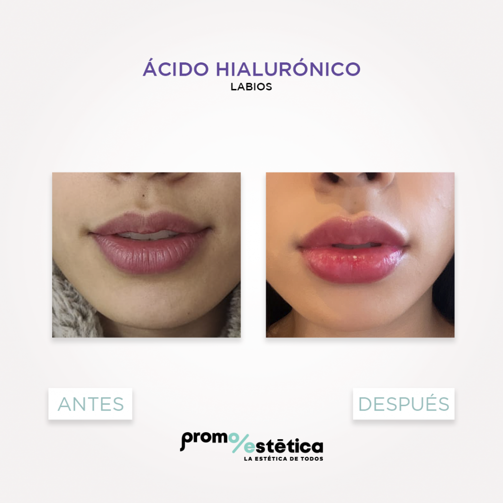 Acido Hialuronico para labios antes y despues 2