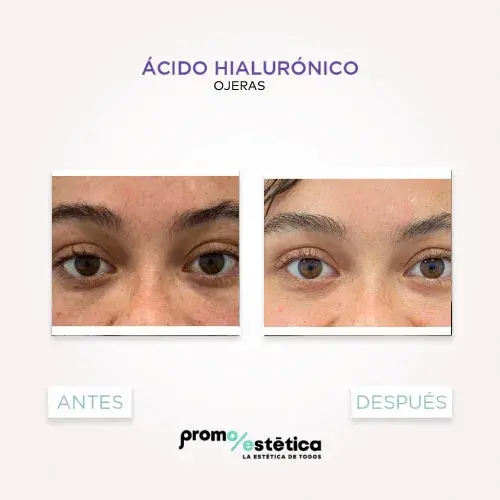 Acido Hialuronico para ojeras antes y despues 2