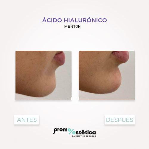 Acido Hialuronico para menton antes y despues 2