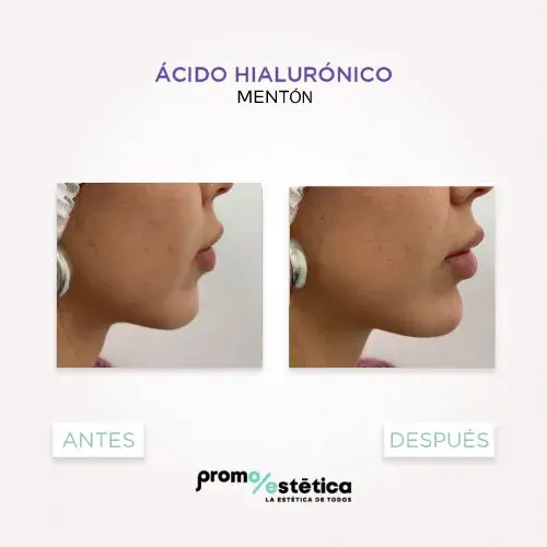 Acido Hialuronico para menton antes y despues