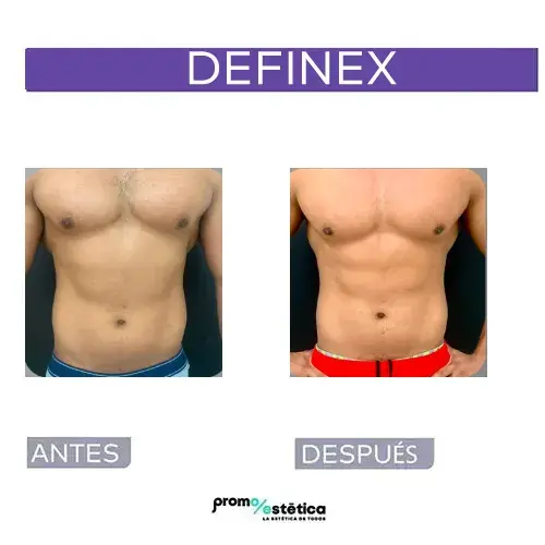 Antes y después de definex en promoestetica