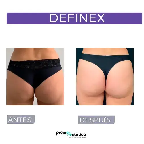 Vitamina c en gluteos + definex antes y despues en Promoestetica