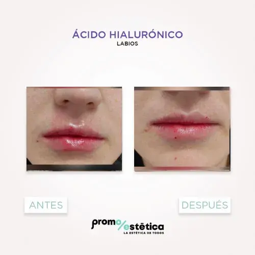 Acido Hialuronico para labios antes y despues 3