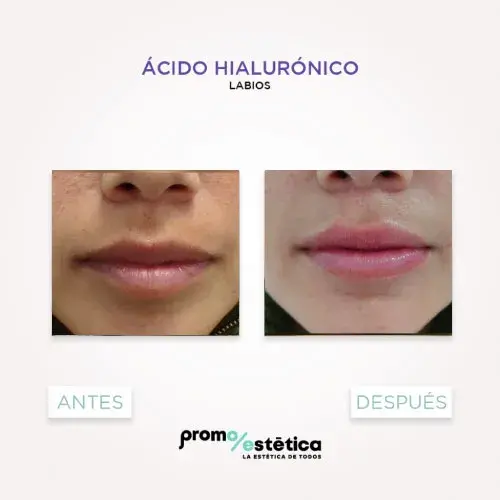 Acido Hialuronico para labios antes y despues