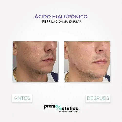 Perfilamiento Facial En promoestetica -antes y después 5