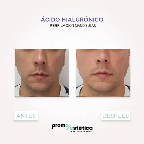 Perfilamiento Facial En promoestetica -antes y después 4