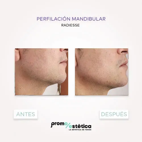 Perfilamiento Facial En promoestetica -antes y después 6