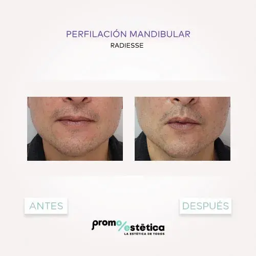Perfilamiento Facial En promoestetica -antes y después 7