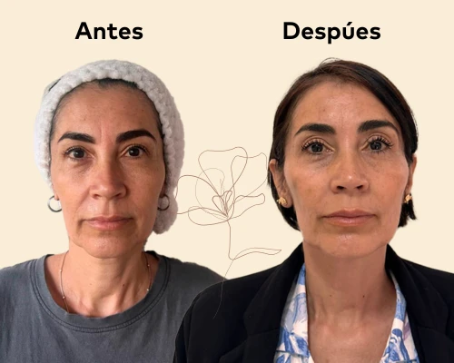 Antes y despúes del segundo tratamiento con Sunekos en Promoestética