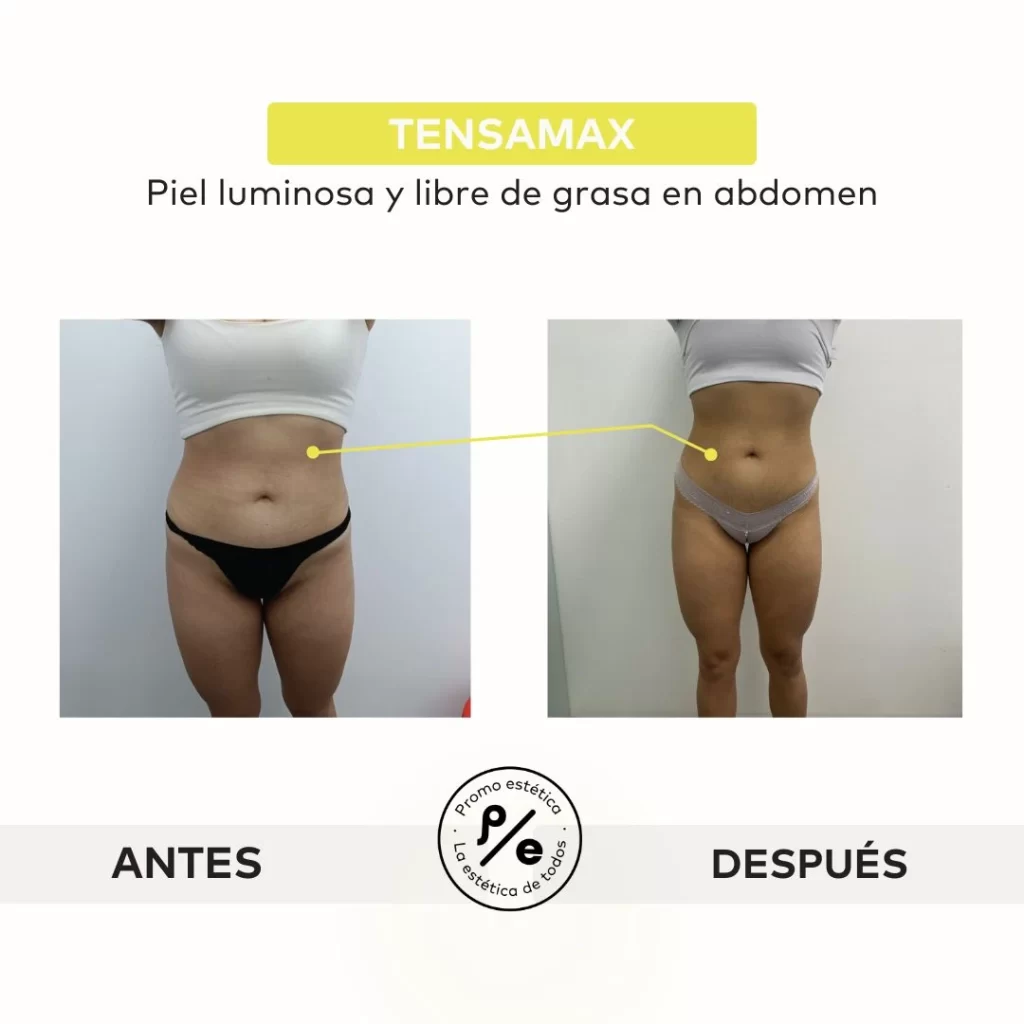 Antes y después del tratamiento Tensamax en Promoestetica