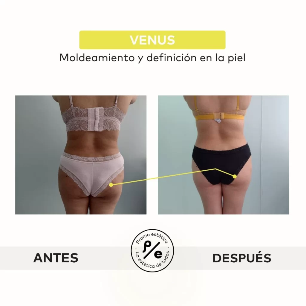 Antes y después del tratamiento venus en Promoestetica