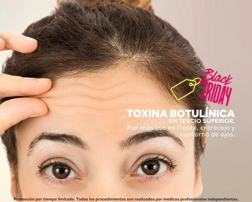 Toxina Botulínica Tercio Superior