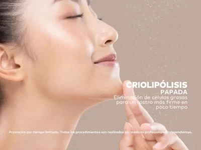Criolipólisis en Papada en Promoestetica